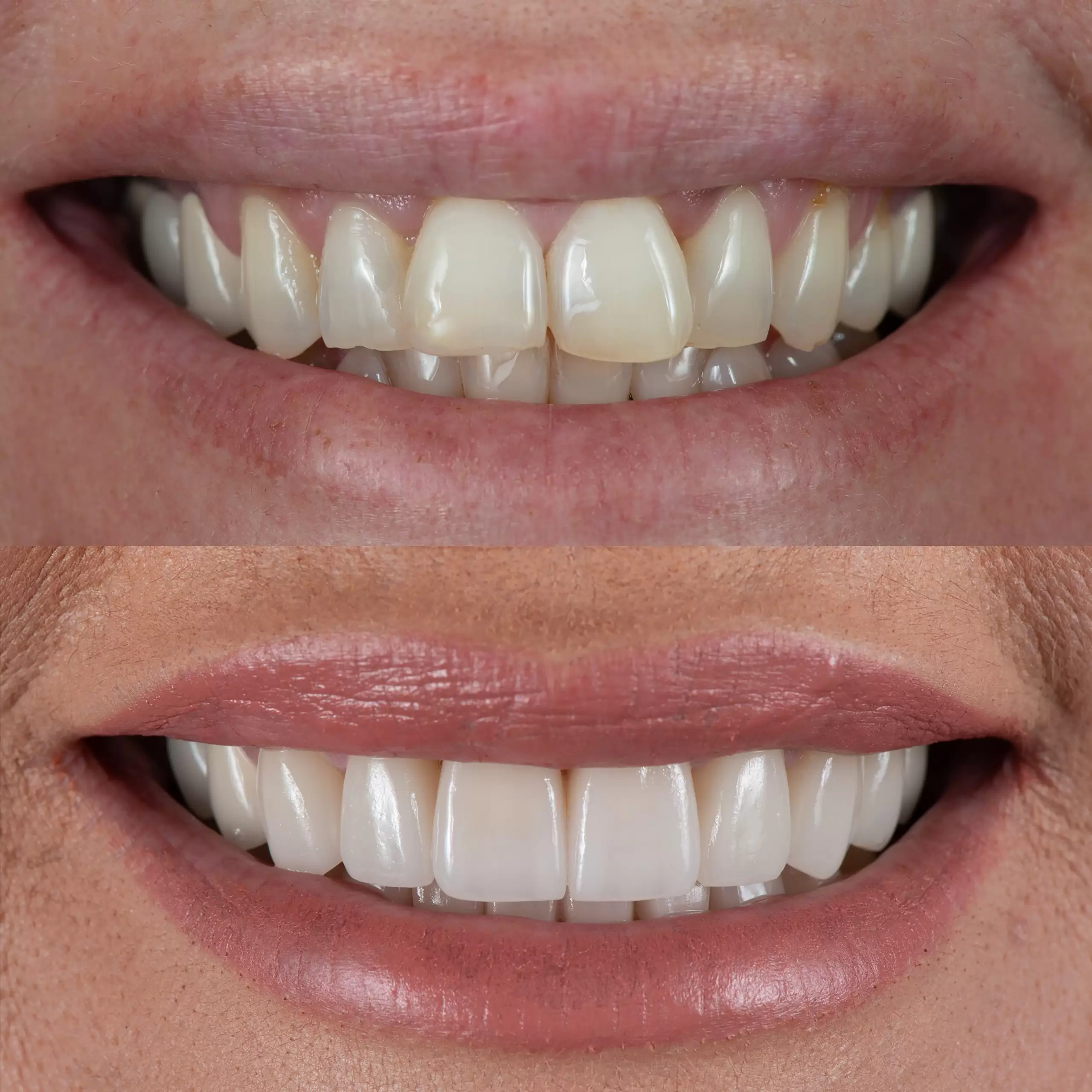 two images of teeths in comparision
