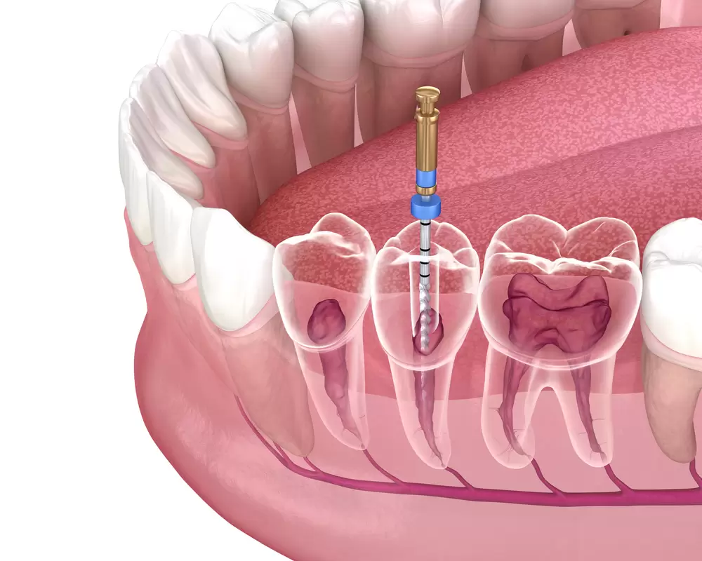Root canal graphic
