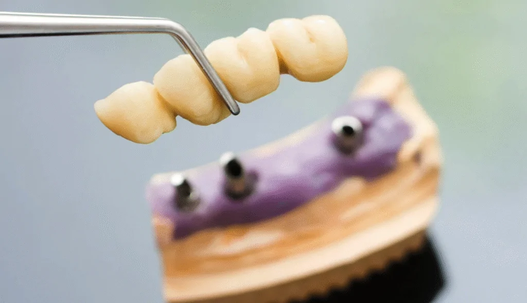 dental bridges