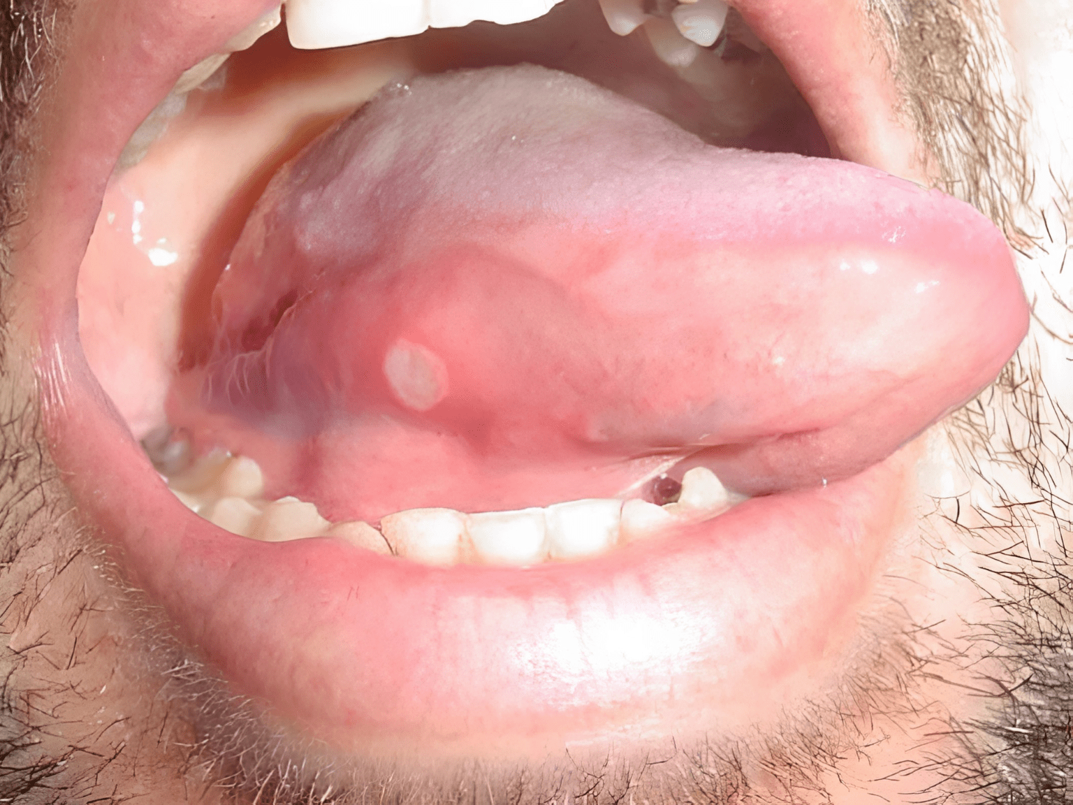 Mouth Sores on or Under the Tongue