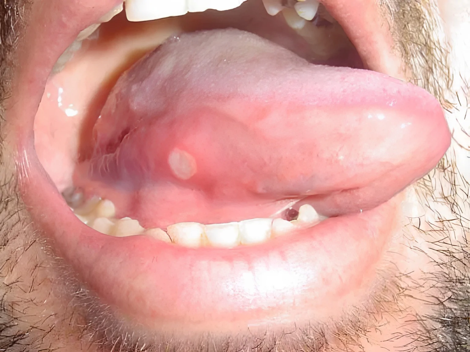 Mouth Sores on or Under the Tongue 