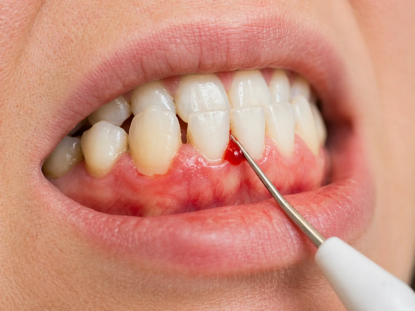 Gum Disease