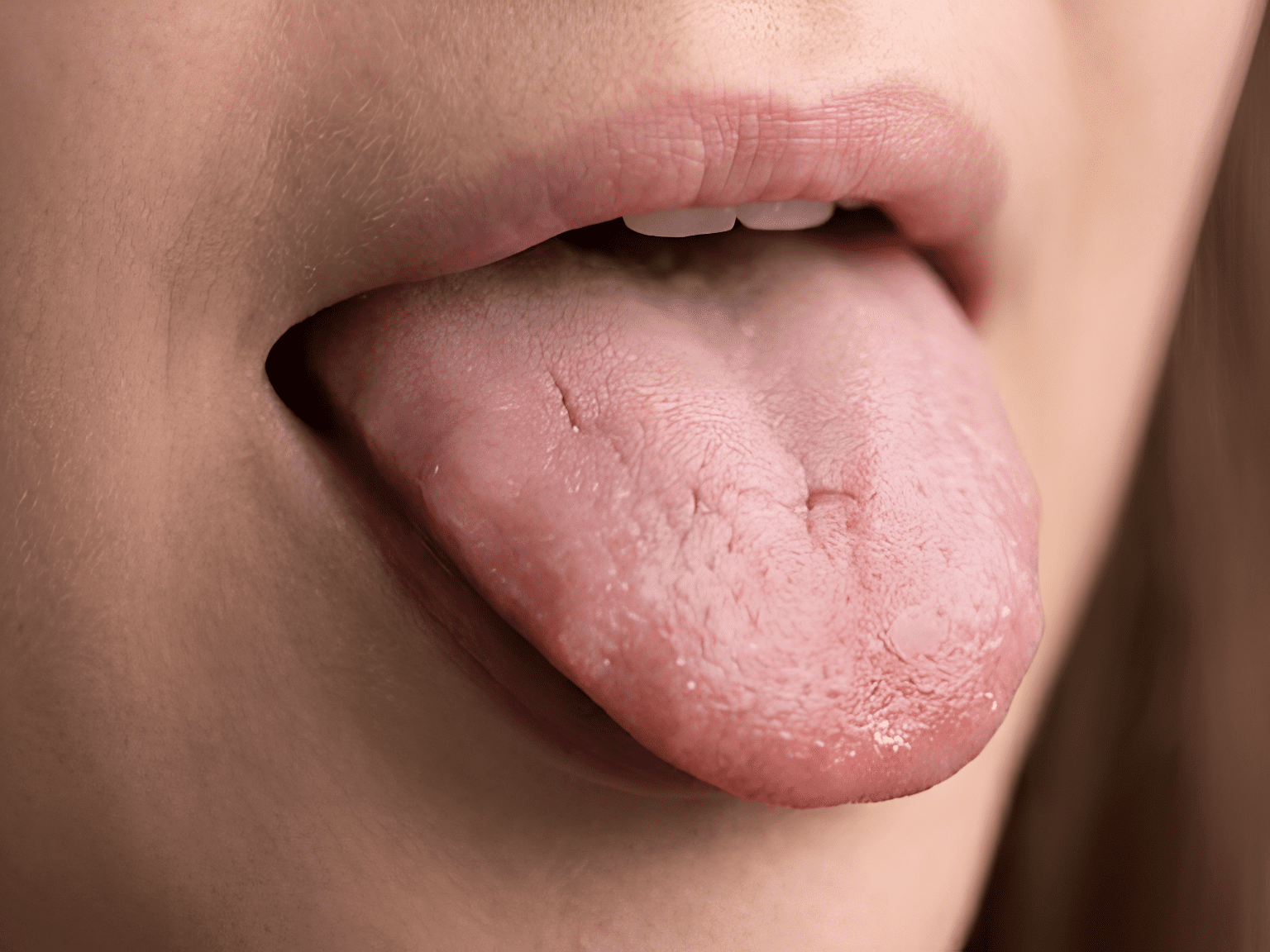 Cracks or Fissures in the Tongue