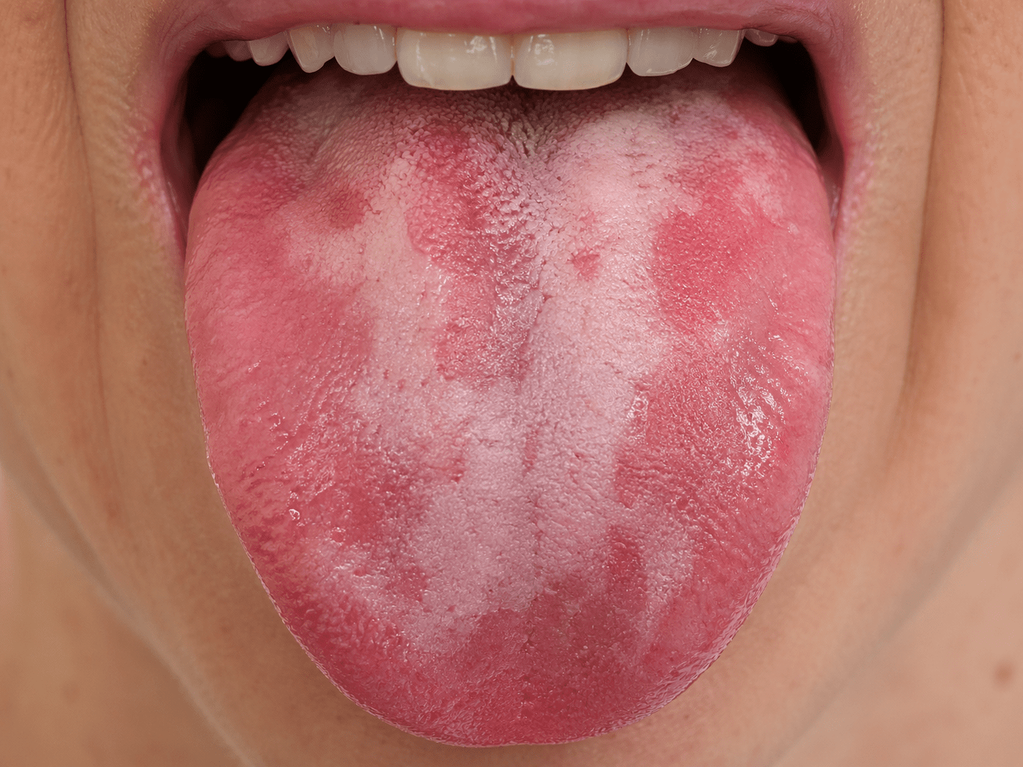 Patches or Discoloration